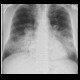 Bronchopneumonia, bilateral: X-ray - Plain radiograph